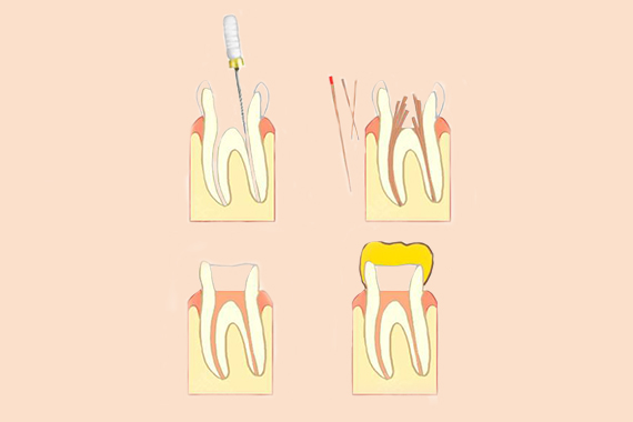 种植牙对周围牙齿有影响吗