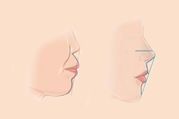 解析唇珠成形术的适应症及特点