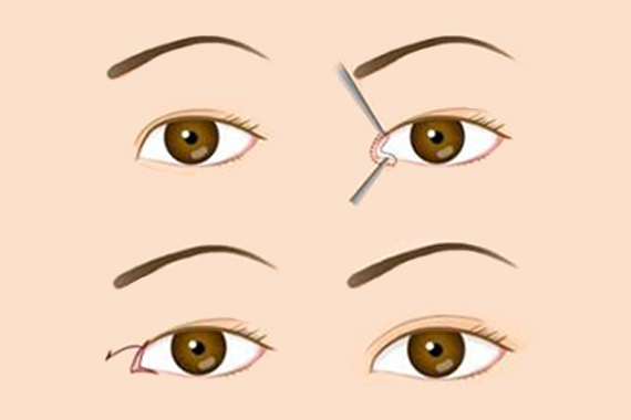 眼睑下垂矫正术的手术方法
