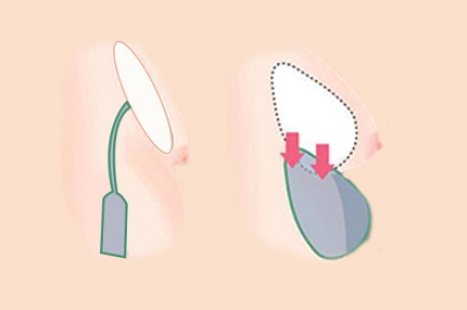 铁岭马晶美容整形门诊的假体隆胸过程你了解吗？