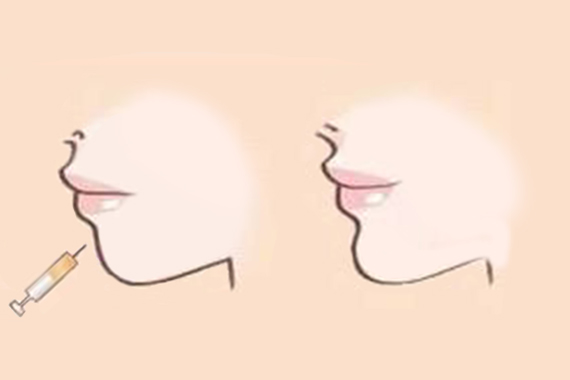  上海科植倍信医疗美容门诊部注射玻尿酸隆鼻的优点有哪些