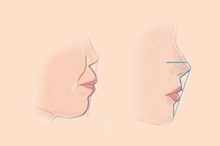 牡丹江亮脸医疗美容门诊部|玻尿酸填鼻唇沟能保持多久