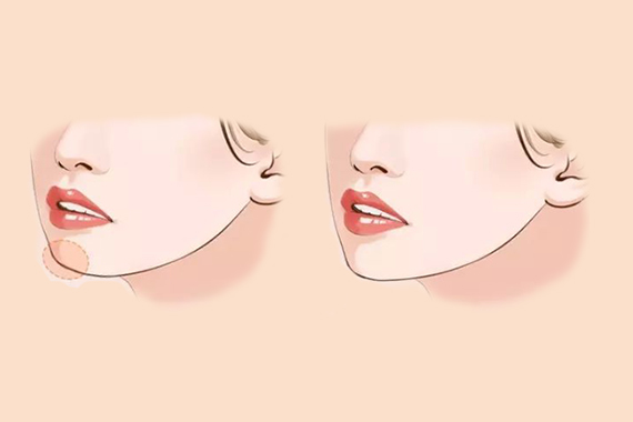 北京佰嘉利医疗美容诊所改脸型手术能改善哪些面部问题