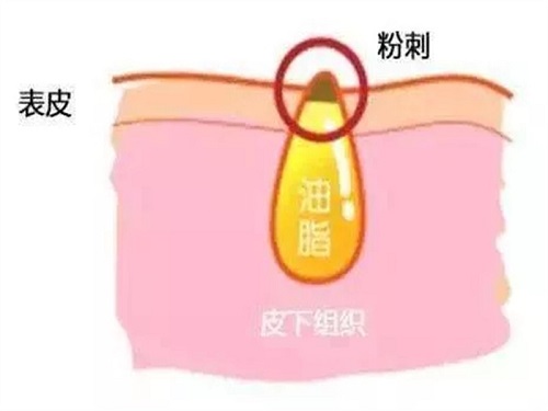 北京依一医疗美容诊所脸部做激光祛痘后要注意什么