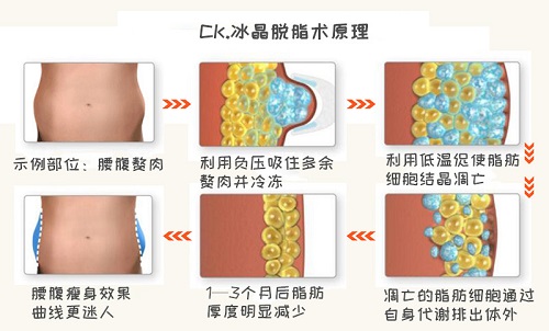  北京熙朵绿地医疗美容门诊部腹部吸脂能维持多久