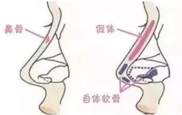 青海省西宁交通医院整形美容科做隆鼻术后惊艳，案例奉上！