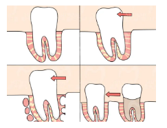 怎么选择医院？牙齿修复的原因有哪些？郑州优植口腔门诊部介绍。