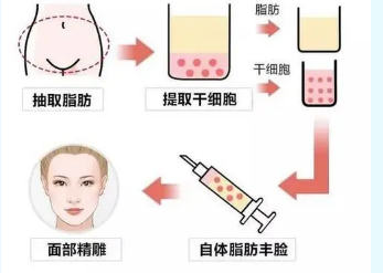 自体脂肪面部填充哪里好?北京科彦医疗美容诊所价格详情。