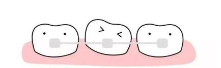 深圳龙普兰特口腔一颗种植牙要多少钱?龙普兰特牙齿矫正案例详情
