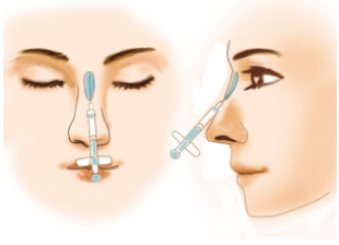 隆鼻术前注意事项有哪些？曹得全专家隆鼻案例来看看吧。