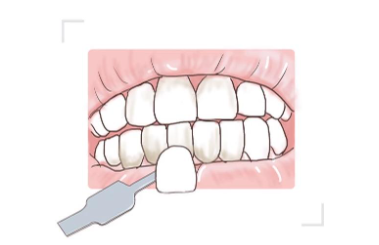 牙齿美白能维持多久？牙齿美白的方法有哪些呢？
