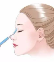 什么因素可以影响鼻综合的价格？做鼻综合多久能恢复良好？