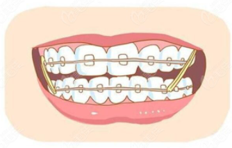 不适合做牙齿矫正的人群有哪些？牙齿矫正会有危害吗？