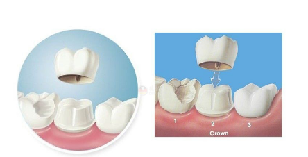 陶瓷贴面牙齿是什么？瓷贴面能维持多久?牙齿价格2022！