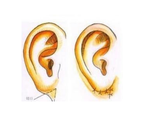 解答耳再造术后的恢复时间！耳再造的风险有哪些?