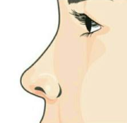 鼻翼缩小整形术有什么危害？鼻翼缩小修复效果怎么样？
