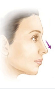 鼻子缩小手术的后遗症有哪些？鼻头能缩小吗？原理!注意事项。