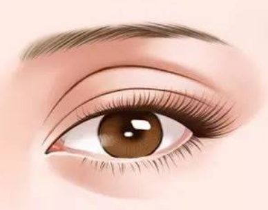 上眼睑松弛适合做什么样的双眼皮？埋线双眼皮手术后注意事项！